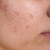 Acne Free Treatment Acne Skin Care Tips to obtain your Neat and Obvious Skin Back