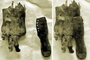 Sebuah mumi yang dipajang di Museum Kairo inilah  Ancient Amputasi (Amputasi berumur 3500 tahun)