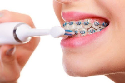 Có thể khắc phục niềng răng bị tụt lợi được không? 2