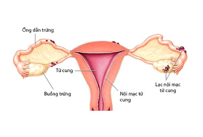 Những bất thường ở tử cung có thể gây vô sinh