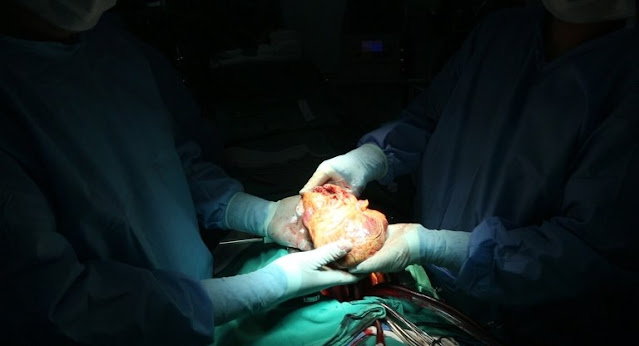 Hospital Metropolitano realiza primeiro transplante de coração em hospital público da Paraíba