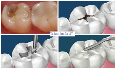 Quy trình thực hiện trám răng thẩm mỹ