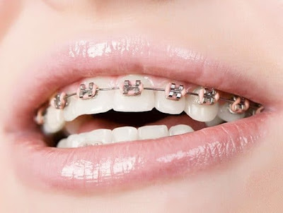 Niềng răng mắc cài kim loại là phương pháp gì?