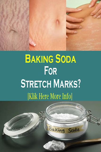 Baking Soda For Stretch Marks