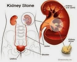 http://penjualanobatherbalalami.blogspot.com/2014/08/cerita-sembuh-dari-penyakit-gagal-ginjal.html