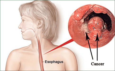 causes-esophagus-cancer