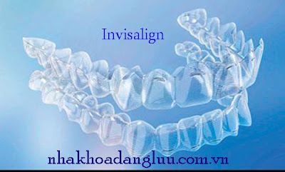 Niềng răng không mắc cài invisalign là gì?