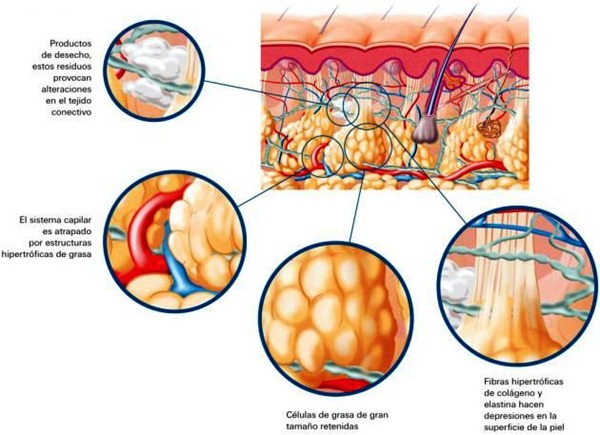 Causas de la celulitis