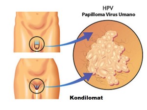 obat kutil kelamin