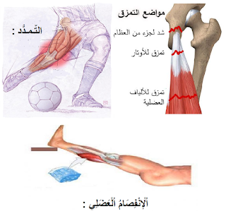 إيقاظ علمي س5: الحوادث الَّتي تصيب العظام و العضلات و المفاصل