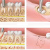 Điều trị đau răng do mọc răng khôn bằng cách nào?