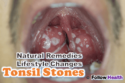 Tonsil Stones: Natural Remedies and Lifestyle Changes to Prevent it