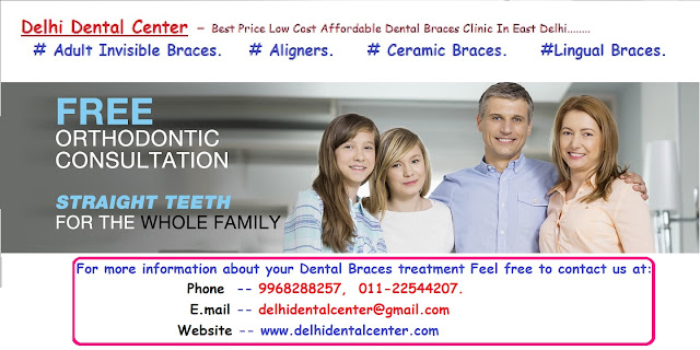 Teeth Braces clinic in Delhi, Teeth braces in Delhi, Teeth Braces dentist in Delhi, Teeth Braces Delhi, Teeth Braces Procedure in Delhi, Teeth Braces Treatment in Delhi.