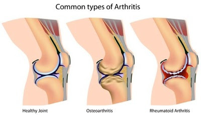 A Better Understanding Of Arthritis
