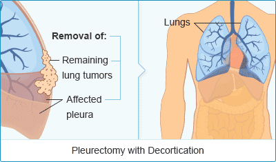 Mesothelioma Radiation