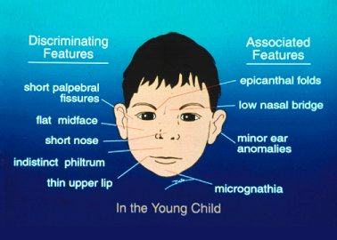 Flat Nasal Bridge And Epicanthal Folds / A depressed nasal ...