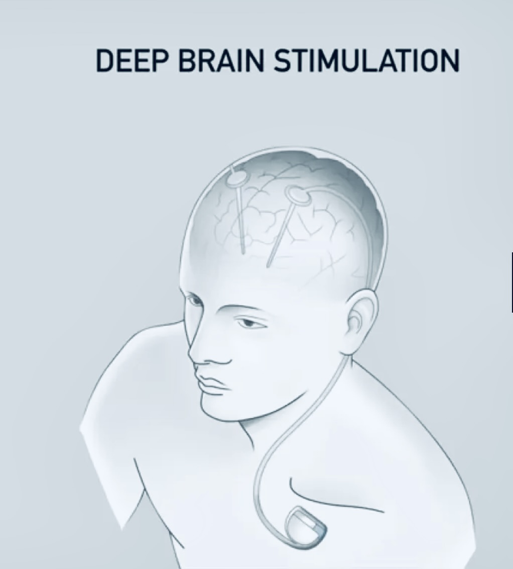 Deep Brain Stimulation