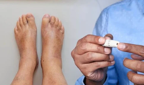 How Do You Treat Diabetic Feet?