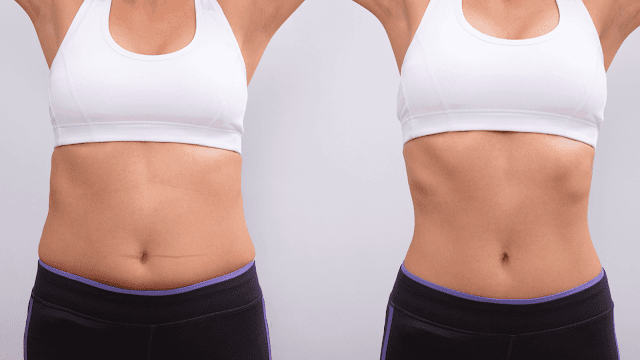 Which Type Of Liposuction Is Best For You By Barbies Beauty Bits
