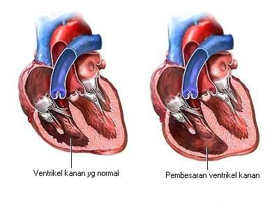 Pembesaran ventrikel kanan