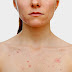 Best Natural Homeopathy Treatment For Skin Disorders