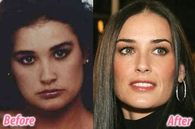 celebrity plastic surgery