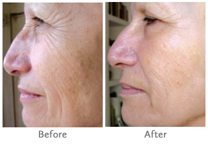 ANTES Y DESPUES