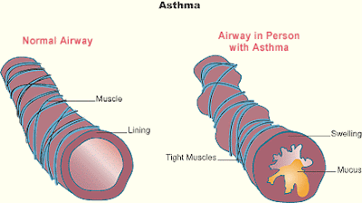 Asthma Disorders of Immune System or Dysfunctions of Immune System Learn with DeepaliTalk