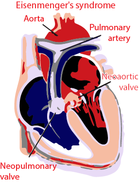 Eisenmenger syndrome