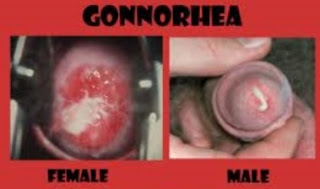Gonorrhea male and female