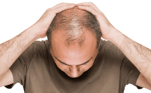 Stop Hair Loss - Vitamins For Hair Loss