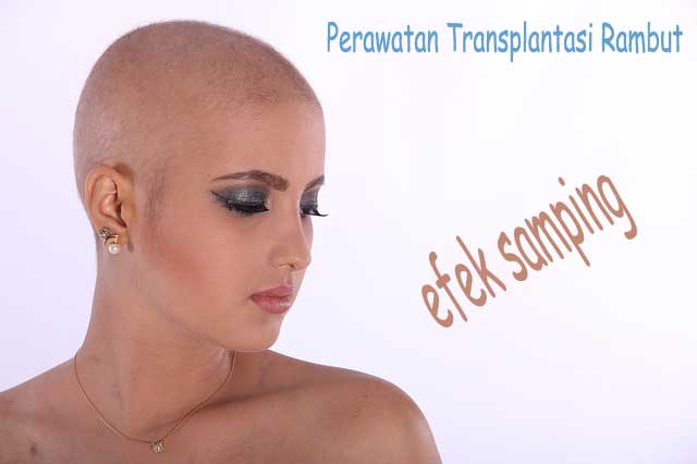 prosedur transplantasi rambut dan efek sampingnya