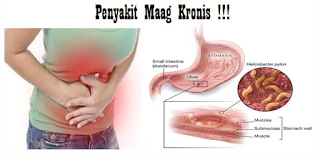 Penyakit Maag Kronis