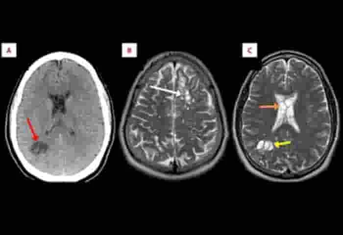 News, Top-Headlines, News-Malayalam-News, National, National-News, Health, Health-News, Lifestyle, Lifestyle-News, Tapeworms found in brain of US man who ate undercooked pork.