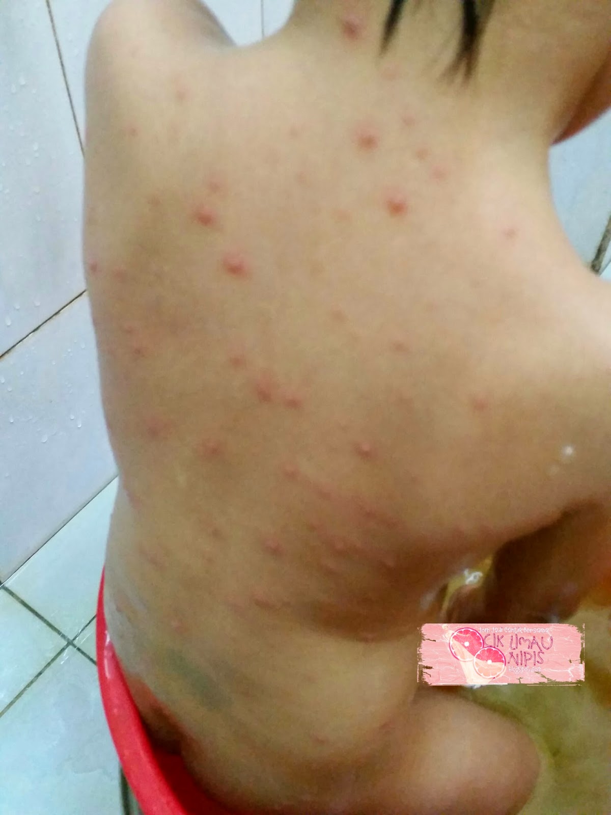 Anak Kena Chicken Pox Cacar Air Syafierayamin Com Beauty Blogger Malaysia