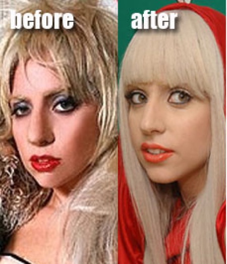 lady gaga before and after surgery