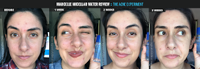 Marcelle Micellar Water Before & After - The Acne Experiment
