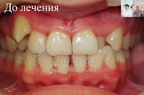Зубы пациента до лечения брекетами