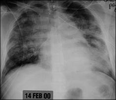 Acute Respiratory Distress Syndrome