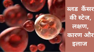 ब्लड कैंसर की लास्ट स्टेज, लक्षण, कारण और इलाज - blood cancer stages and treatment in hindi