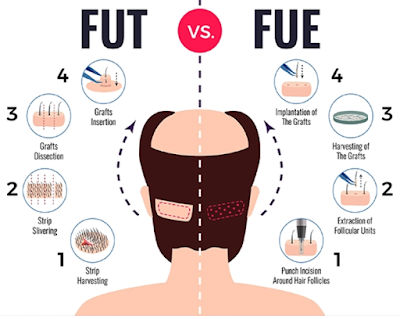 Vera clinic의 설명자료 FUT FUE비교