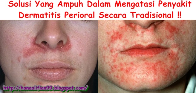 Obat Tradisional Dermatitis Perioral