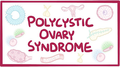 Polycystic Ovarian Syndrome 