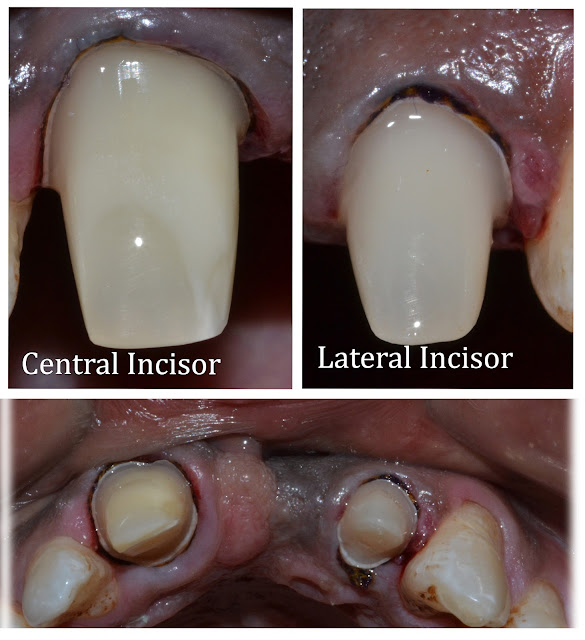 Teeth Preparation and Gingival Retraction for Bridge