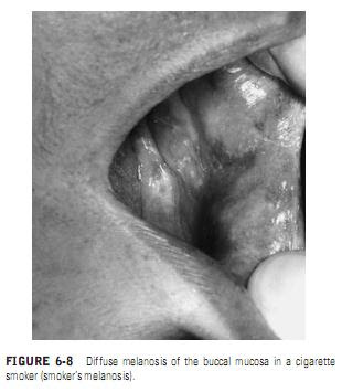 Smoker’s Melanosis