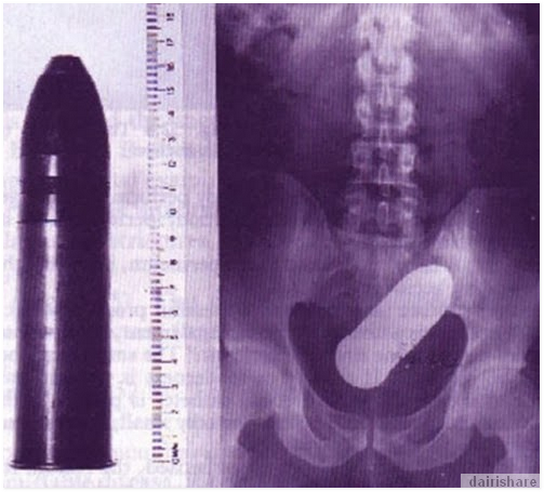 X-RAY PERBUATAN PALING BODOH MANUSIA