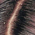 Brief:  Meaning of Dandruff, and it causes.