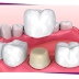 Một số nguyên nhân khiến răng bị sứt