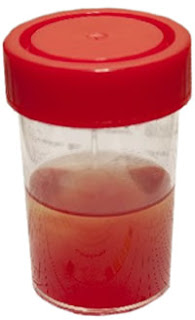 IgA Nephropathy with blood in urine