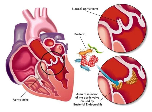 Infective Endocarditis, Bacterial Endocarditis